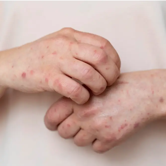 Pharmacy First Impetigo - Scratching Hands